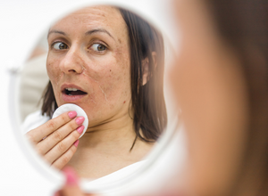 une femme qui a des tâches brunes sur le visage