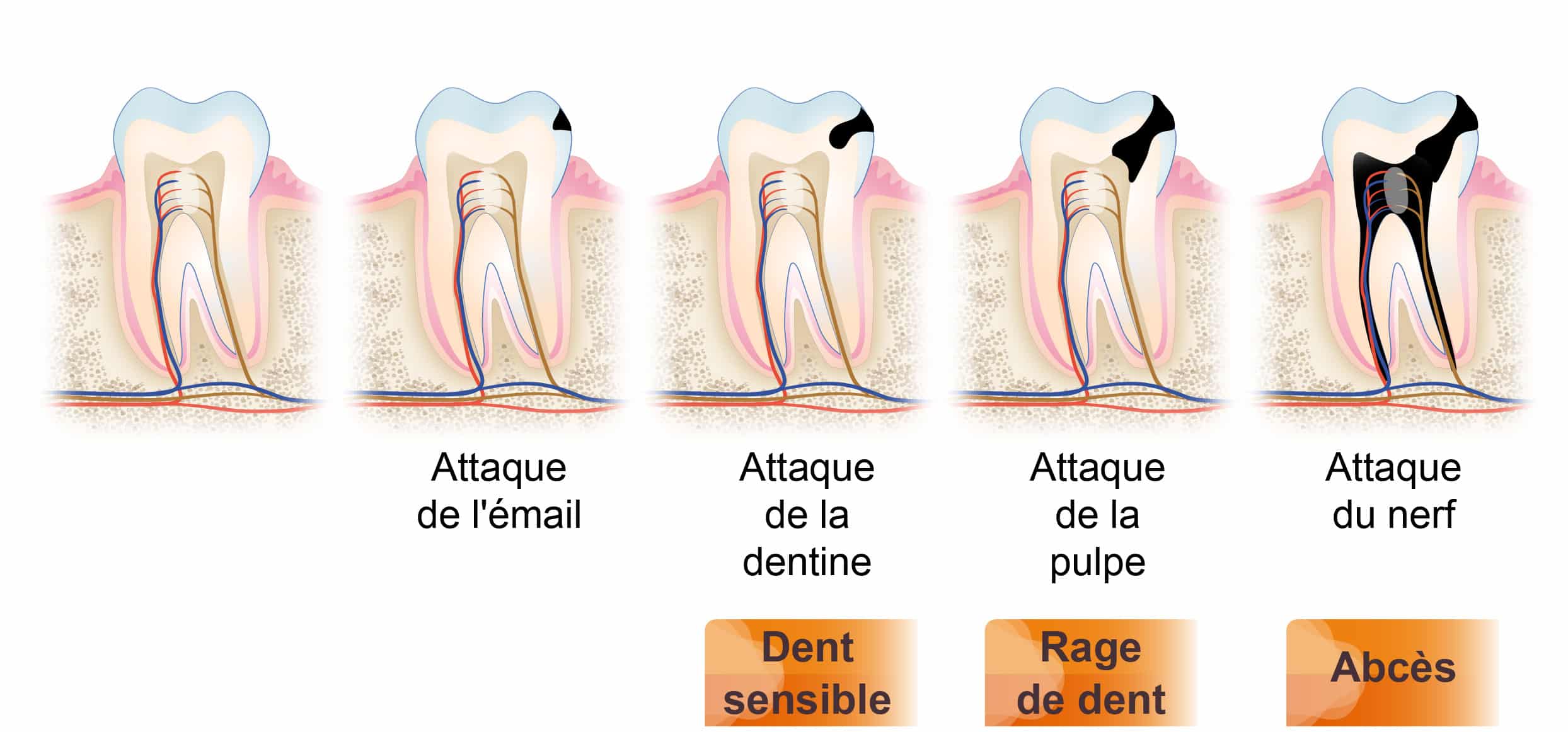 abcès dentaire