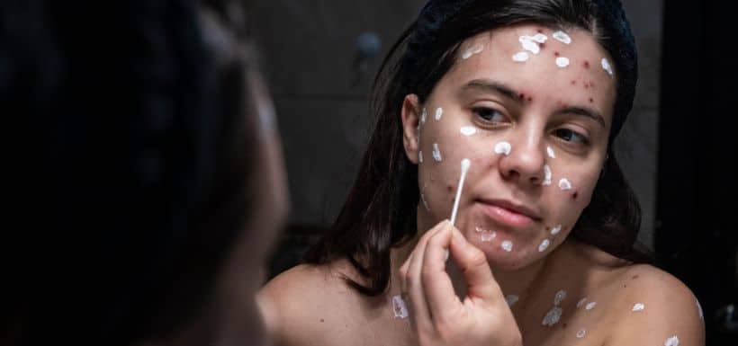 Une femme applique de la crème sur les boutons qu'elle a sur le visage. 