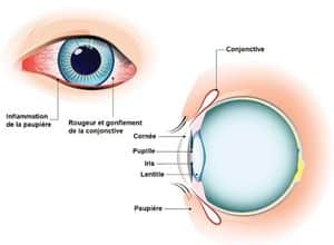 conjonctivite