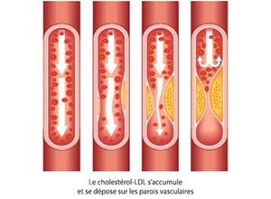 le cholestérol s'accumule et se dépose sur les parois vasculaires