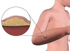 Schéma d'un lipome 