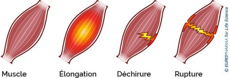 Déchirure musculaire