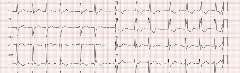 Fibrillation atriale