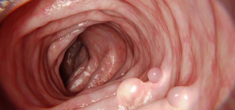 FODMAP, des sucres qui altèrent la barrière intestinale