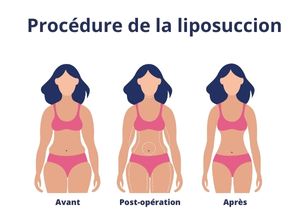 procédure de la liposuccion