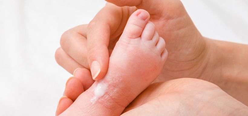 pieds de bébé eczema