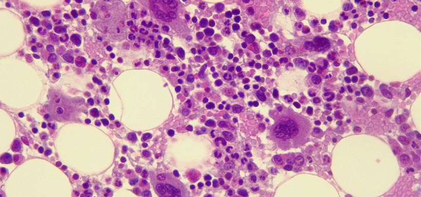 Vu au microscope du sang interleukine polyarthrite rhumatoïde