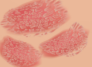 Diagnostic lichen plan