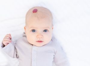 Photo d'un bébé avec un hémangiome infantile sur la tête.