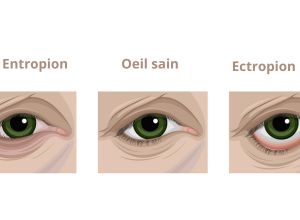 Ectropion, entropion et oeil sain en comparaison