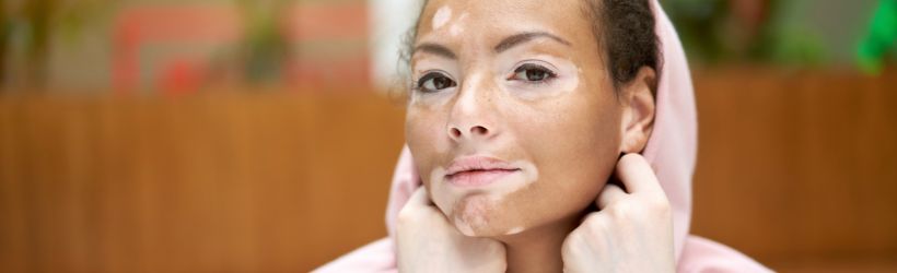 femme ayant le vitiligo