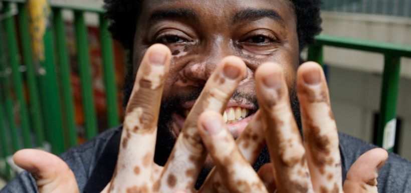 vitiligo cancer