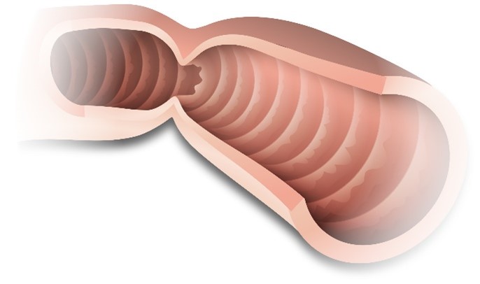 schéma colon occlusion intestinale