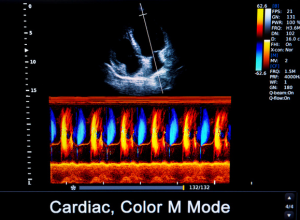 définition echodoppler