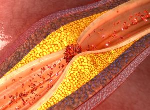 infarctus myocarde