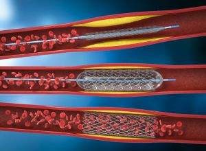 traitement myocarde