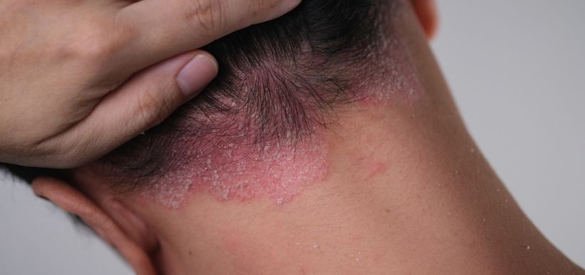 Homme atteint de Psoriasis